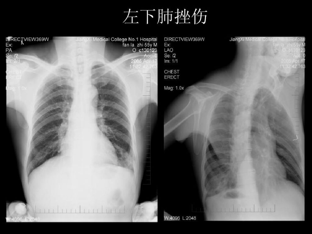 隔肌在哪(膈肌的作用是什么)