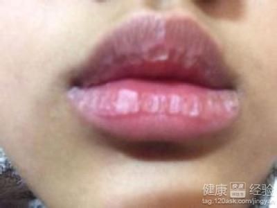 唇炎怎么治都不好(唇炎长期不好怎么办)
