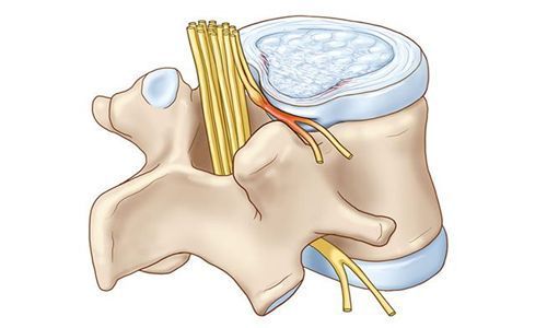 腰间盘突出会不会有积液(腰间盘突出会引起哪些症状)