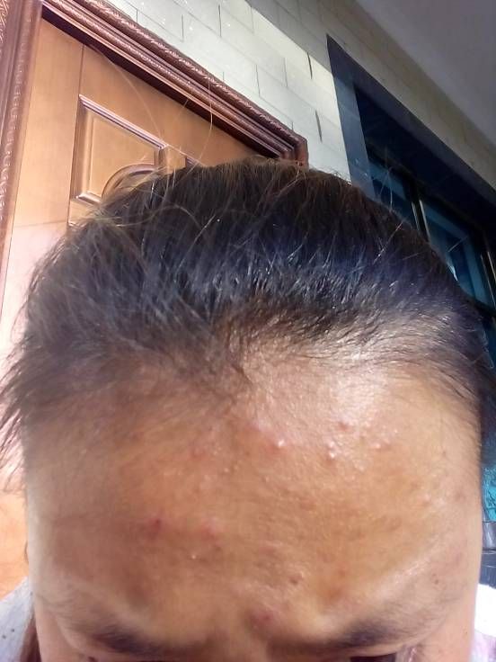 粉刺挤出来黄色硬的怎么回事(胸部挤出来黄色的东西是怎么回事)