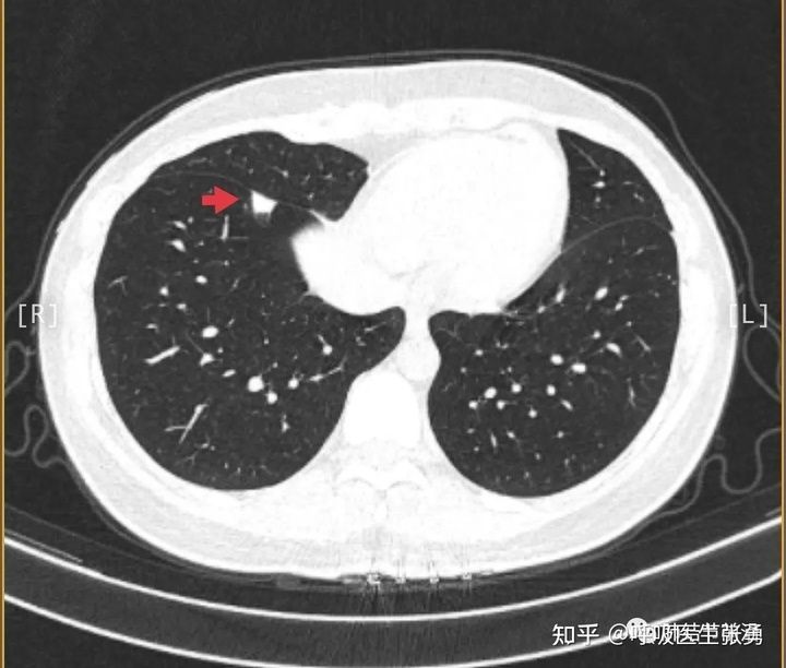 左肺上尖叶后段非实性结节的简单介绍