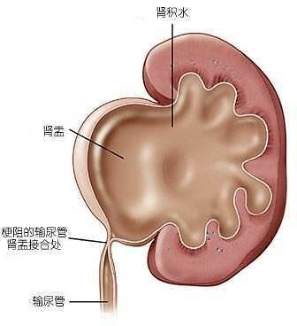 女性输尿管下端结石能自己排出吗的简单介绍