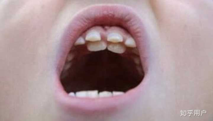 牙齿上有包可以拔吗的简单介绍