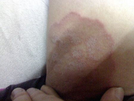 大腿内侧偏上疼吃什么药的简单介绍