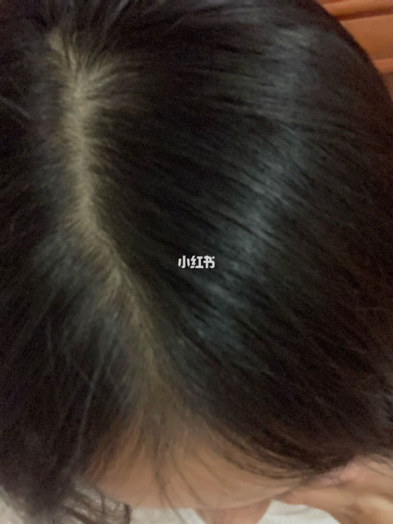 最近掉头发严重是不是有病(最近掉头发严重是什么原因女性)