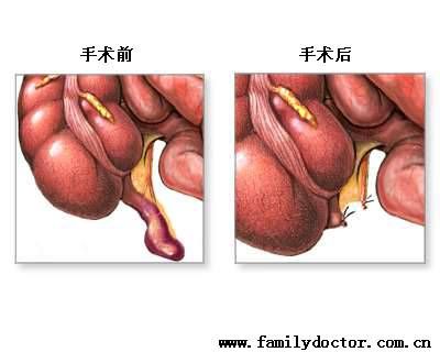 男生阑尾在哪边(男生阑尾在哪边图片)