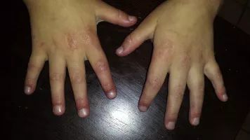 手关节碰到了疼不红不肿的简单介绍