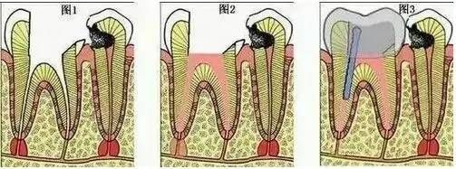 牙釉质在哪(牙釉质脱矿自己恢复了)