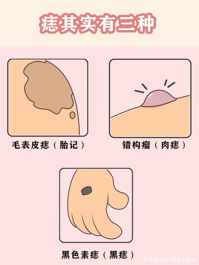 是非痣在哪里(是非痣是在哪里的)