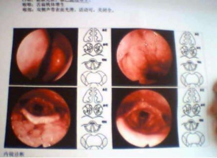 扁桃体手术后需要消炎几天才能出院的简单介绍