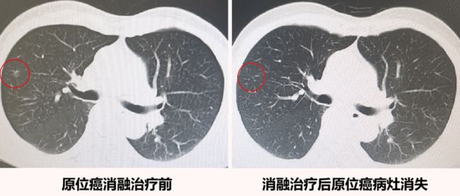 呼吸与肺结节(呼吸与肺结节诊疗)