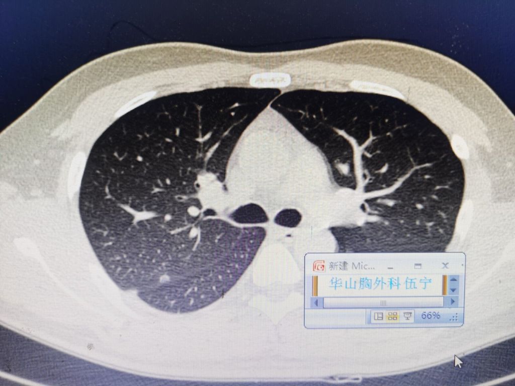 肺部结节位置离大的血管近怎么办的简单介绍