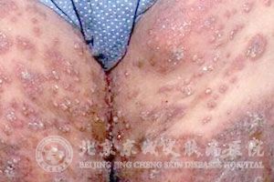 结节性痒疹膏在哪买(结节性痒疹擦什么药膏)