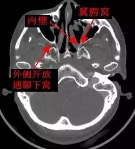 翼突在哪(翼突在口腔什么位置)