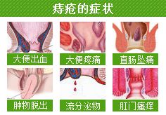 痔疮长在哪里图片(痔疮的位置在哪个部位图片)