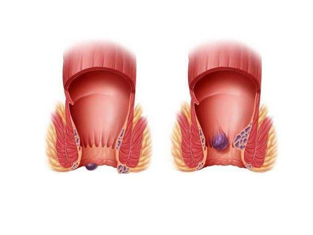 外痔疮长在哪里的简单介绍