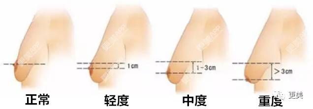 胸位在哪(胸位在哪里是正常的)