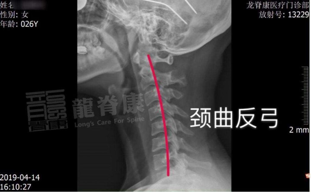 颈椎2在哪里(颈椎2在哪个部位)