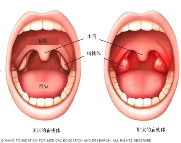 扁桃体长在哪里(扁桃体息肉长在哪里)