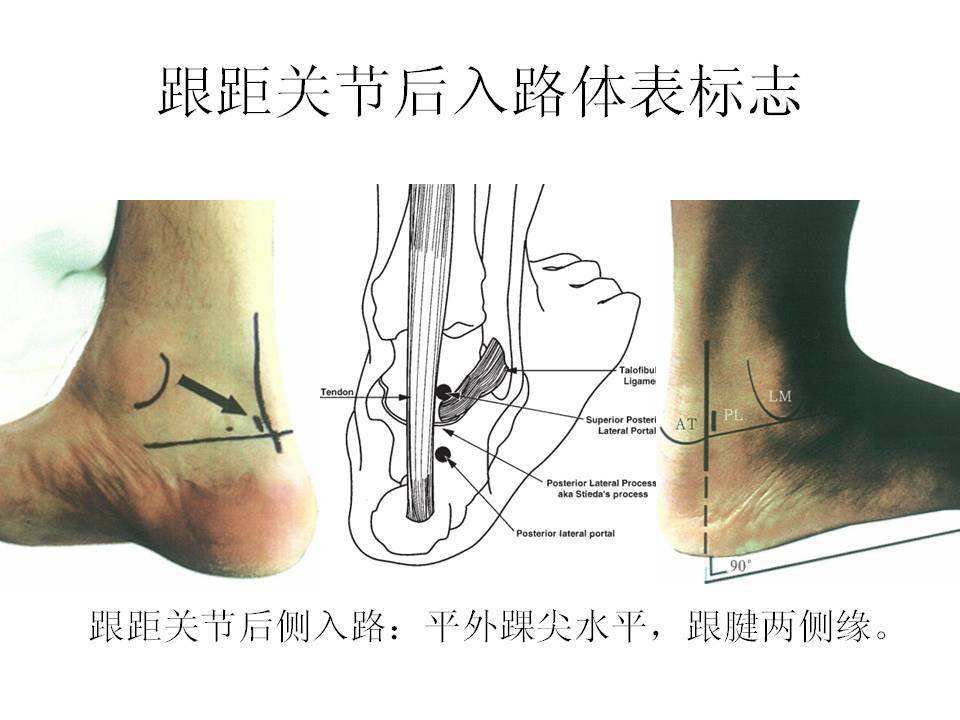 右跟骨在哪(右跟骨可见小结节状高密度影)