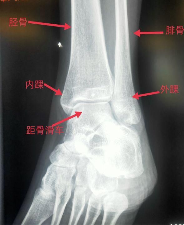 内踝线在哪里(胫骨内踝在哪里)