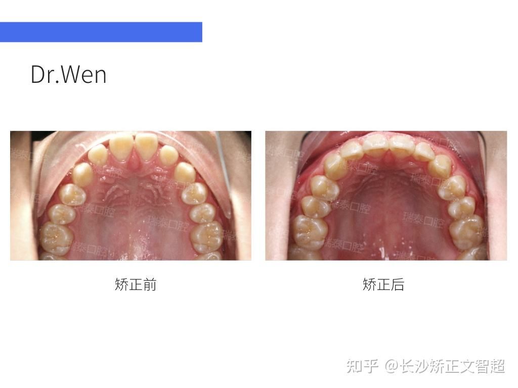 牙槽突在哪(牙槽突裂植骨术)