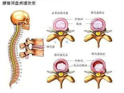 腰椎间在哪里(腰椎肿瘤一般长在哪里)