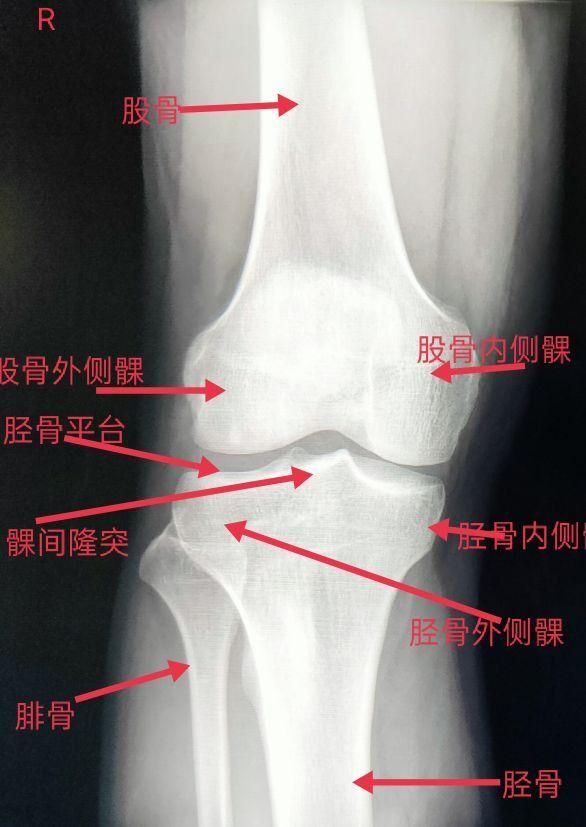 胫骨骨在哪里(胫骨远端在哪里)