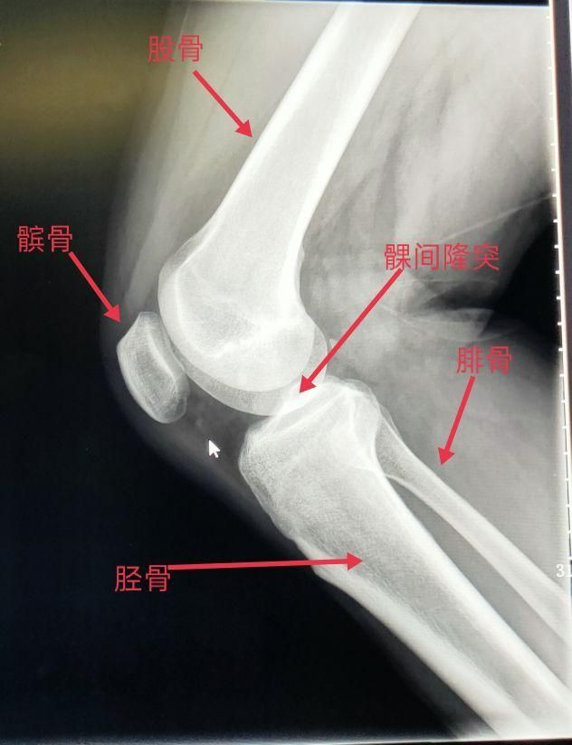 胫骨骨在哪里(胫骨远端在哪里)