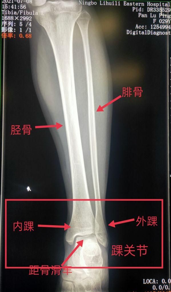 胫骨骨在哪里(胫骨远端在哪里)