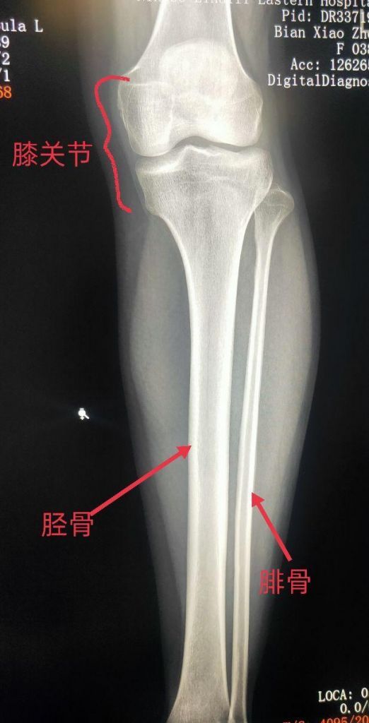 胫骨骨在哪里(胫骨远端在哪里)