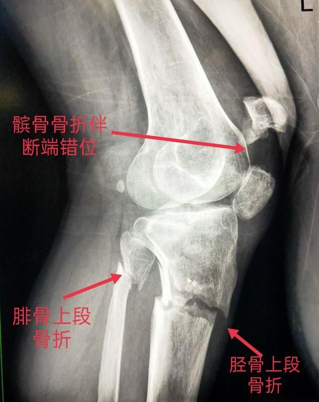 胫骨骨在哪里(胫骨远端在哪里)