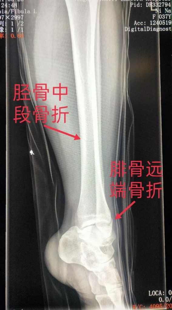 胫骨骨在哪里(胫骨远端在哪里)