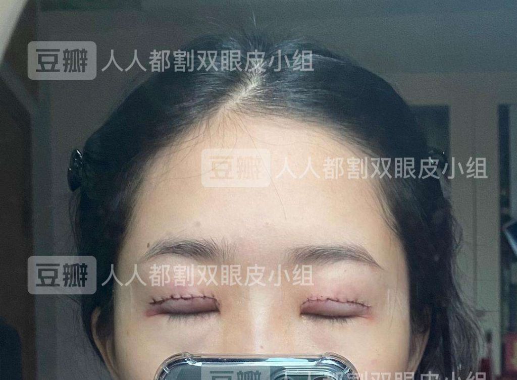 眼膏抹在哪里(红霉素眼膏抹在哪里)