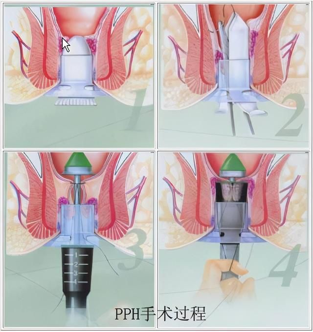 肛管齿在哪里(肛管6点在哪里)