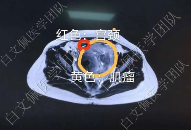 盆腔在哪个位置图解(盆腔在哪个位置图片)