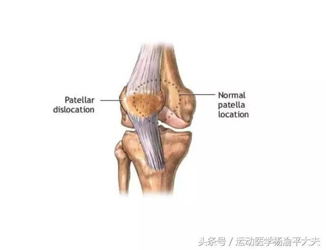 髌骨在哪个位置(髌骨在哪个位置示意图)
