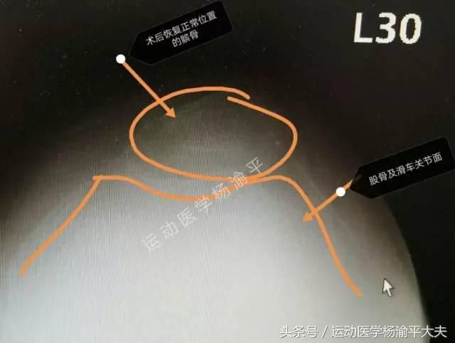 髌骨在哪个位置(髌骨在哪个位置示意图)