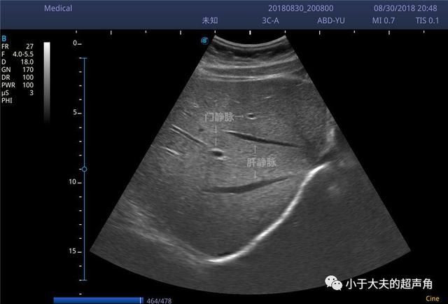 肝右后叶在哪(肝右后叶钙化灶是什么意思)
