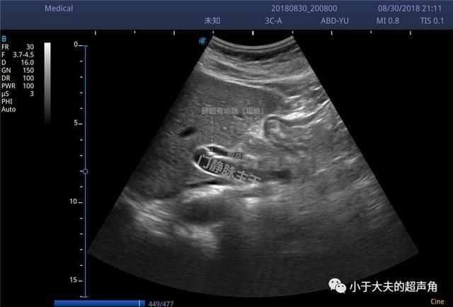 肝右后叶在哪(肝右后叶钙化灶是什么意思)