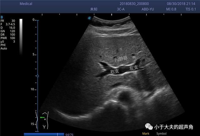 肝右后叶在哪(肝右后叶钙化灶是什么意思)