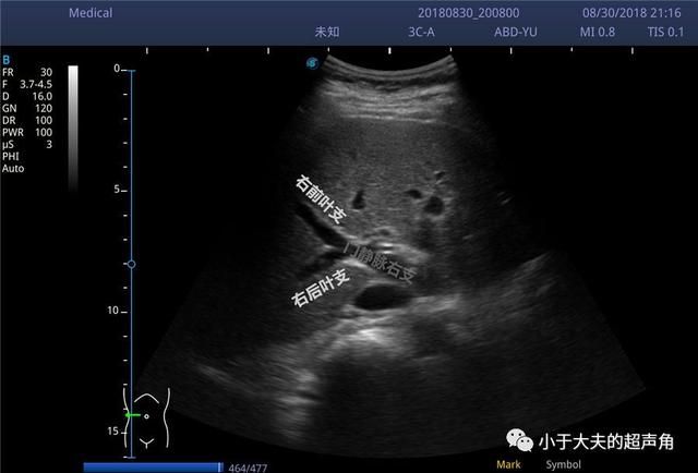 肝右后叶在哪(肝右后叶钙化灶是什么意思)