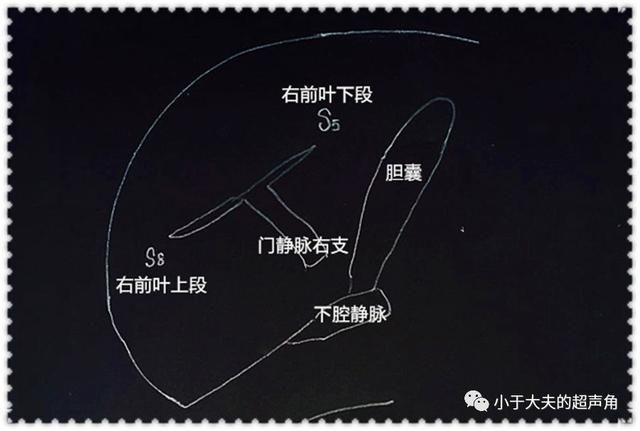 肝右后叶在哪(肝右后叶钙化灶是什么意思)