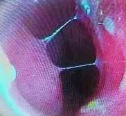 下鼻甲在哪个位置(双侧下鼻甲在哪个位置)