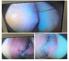 下鼻甲在哪个位置(双侧下鼻甲在哪个位置)