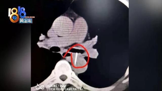 胸放在哪针的简单介绍