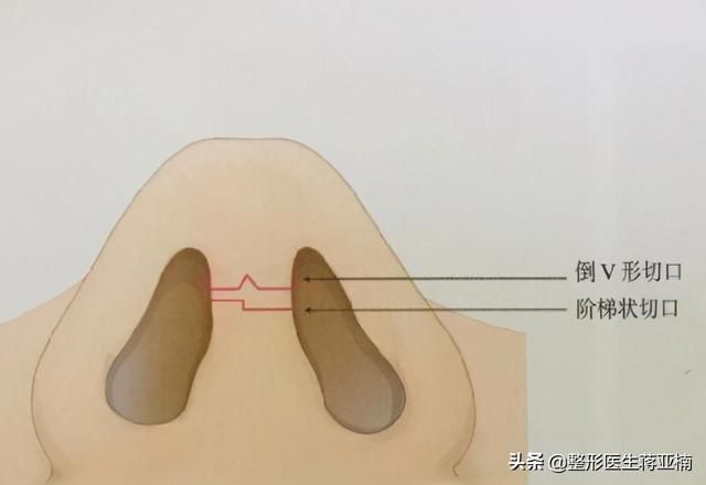 隆鼻假体放在哪里(假体隆鼻假体放在哪个层次)